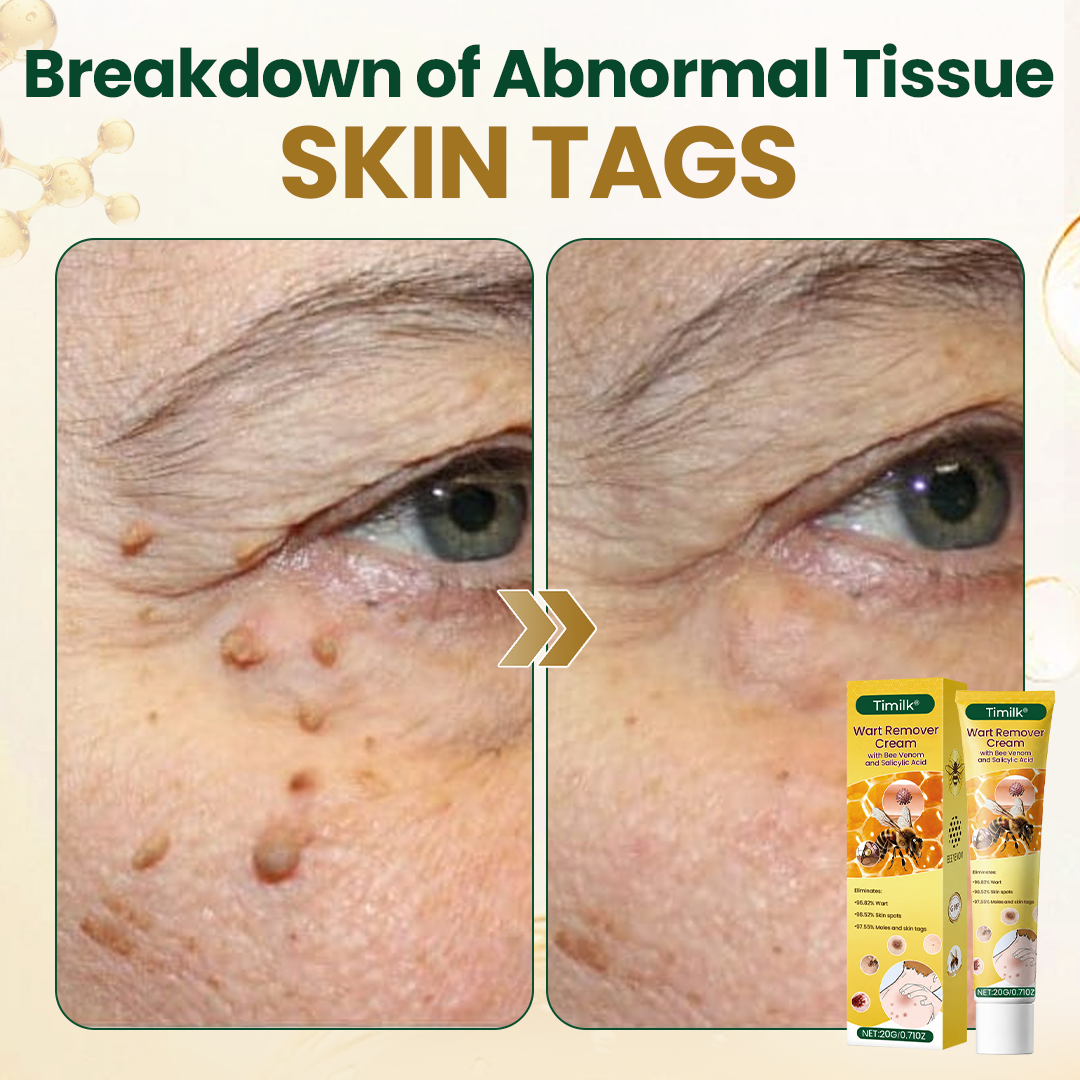 Timilk® Wart Remover Cream with Bee Venom and Salicylic Acid – Skin Tag Removal & Skin Repair Formula for Face and Body